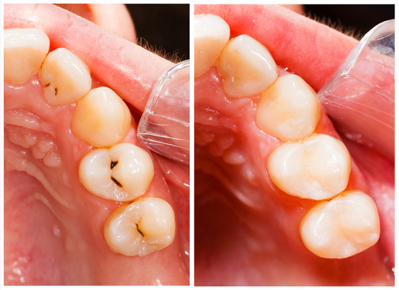 Fillings  Macclenny, FL 