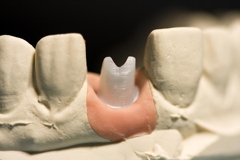 Implant Restoration  Macclenny, FL 